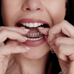 Smile with Clear Aligners