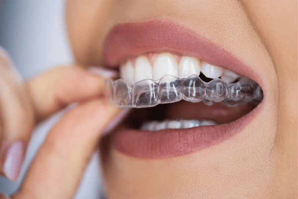 Clear Aligners for Upper Teeth