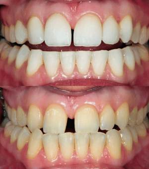 Teeth Straightening Care