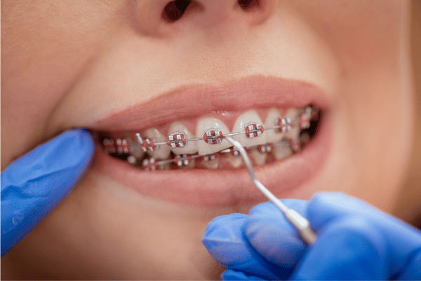 Do Braces Hurt? Your Ultimate Guide