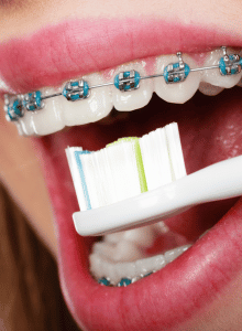 Brushing with braces